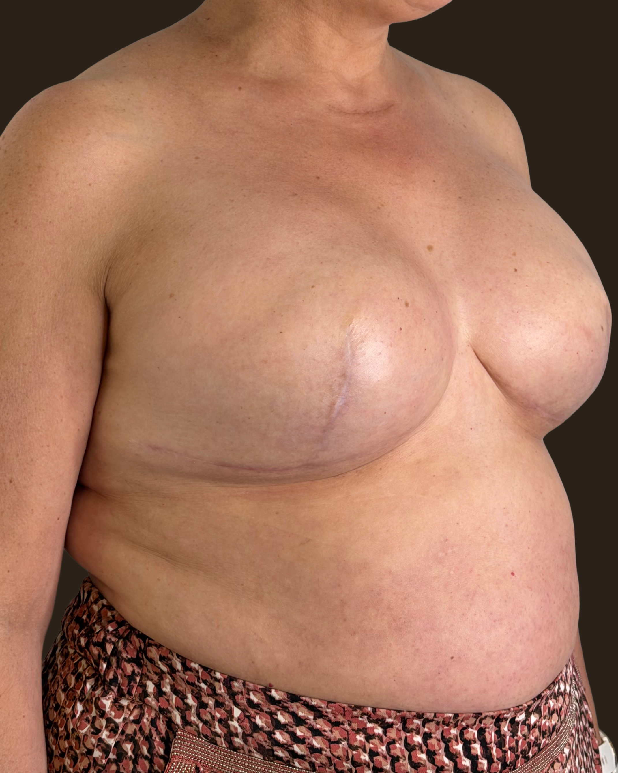 Pecho tras doble mastectomía por cáncer de mama, sin complejo areola-pezón, antes de la reconstrucción con prótesis de silicona