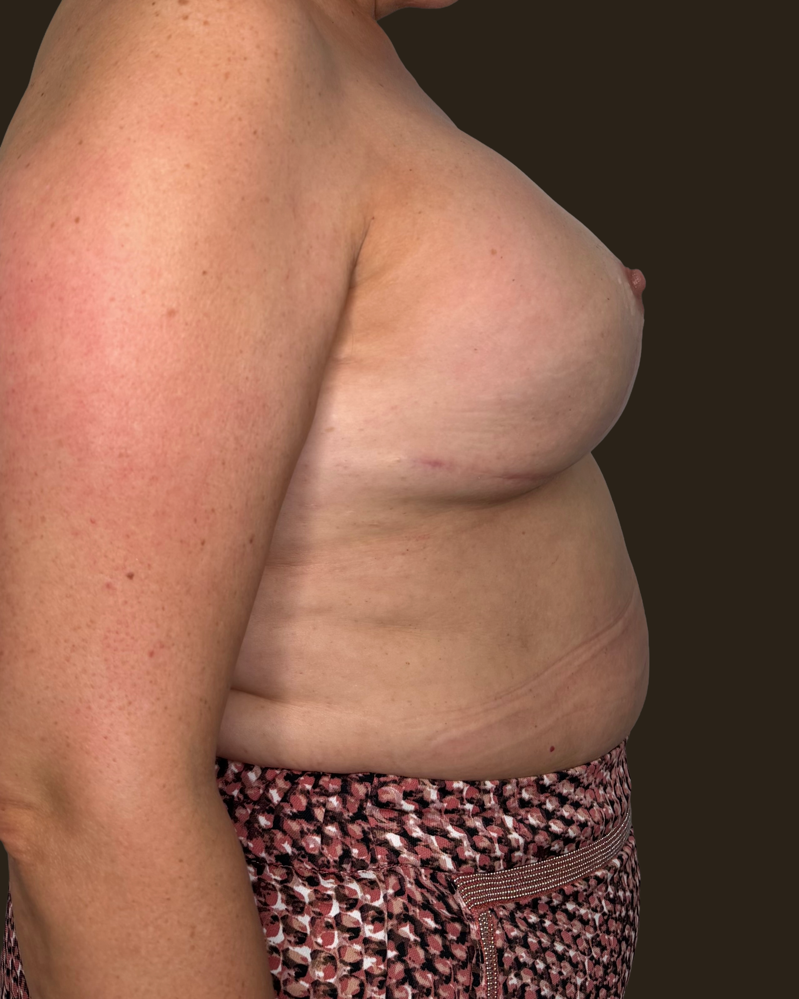 Resultado final de prótesis de pezón hiperrealista, vista lateral, mostrando volumen y textura tridimensional