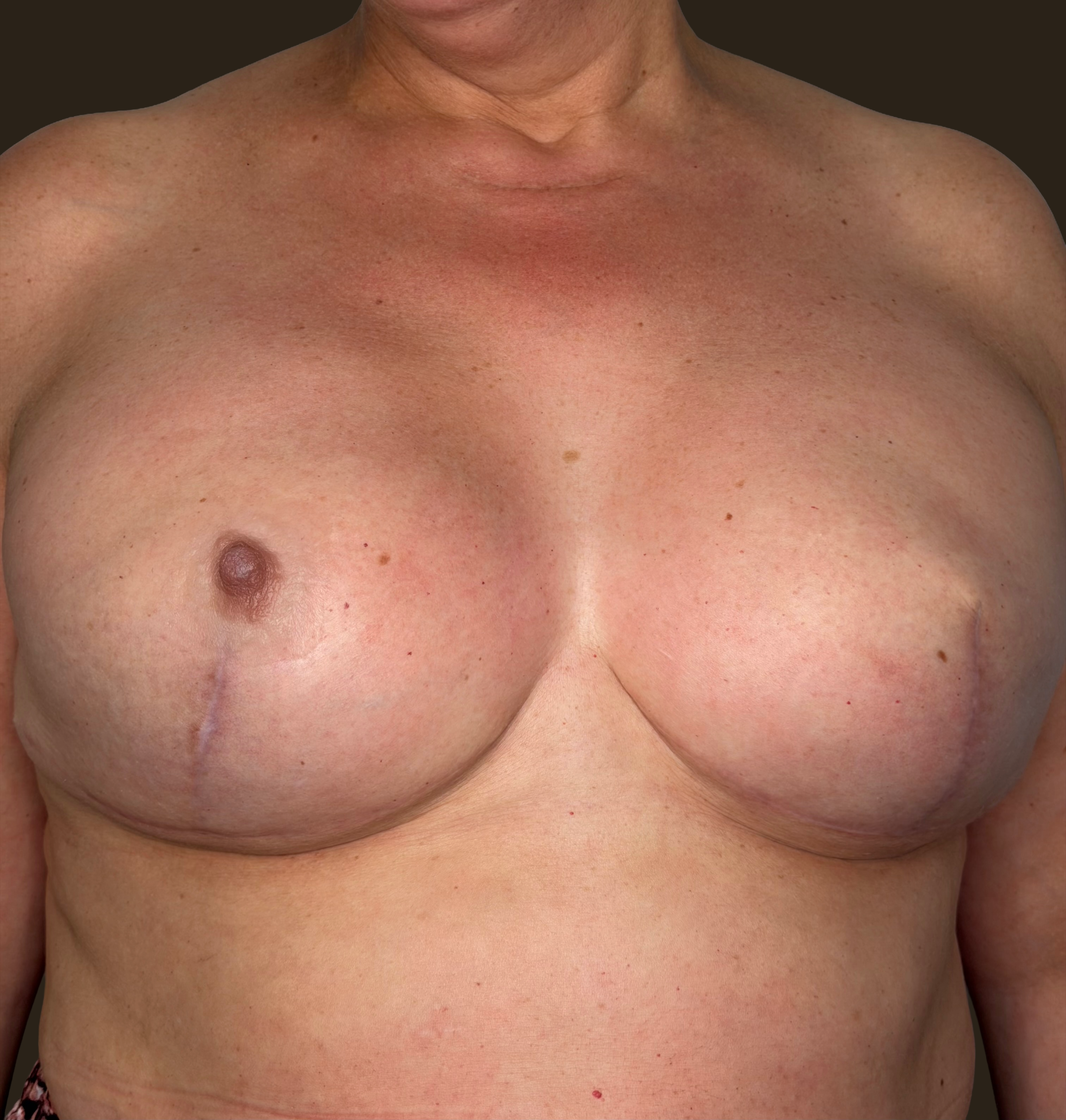 Resultado final de prótesis hiperrealista de areola-pezón de silicona médica personalizada en mujer mastectomizada, vista frontal