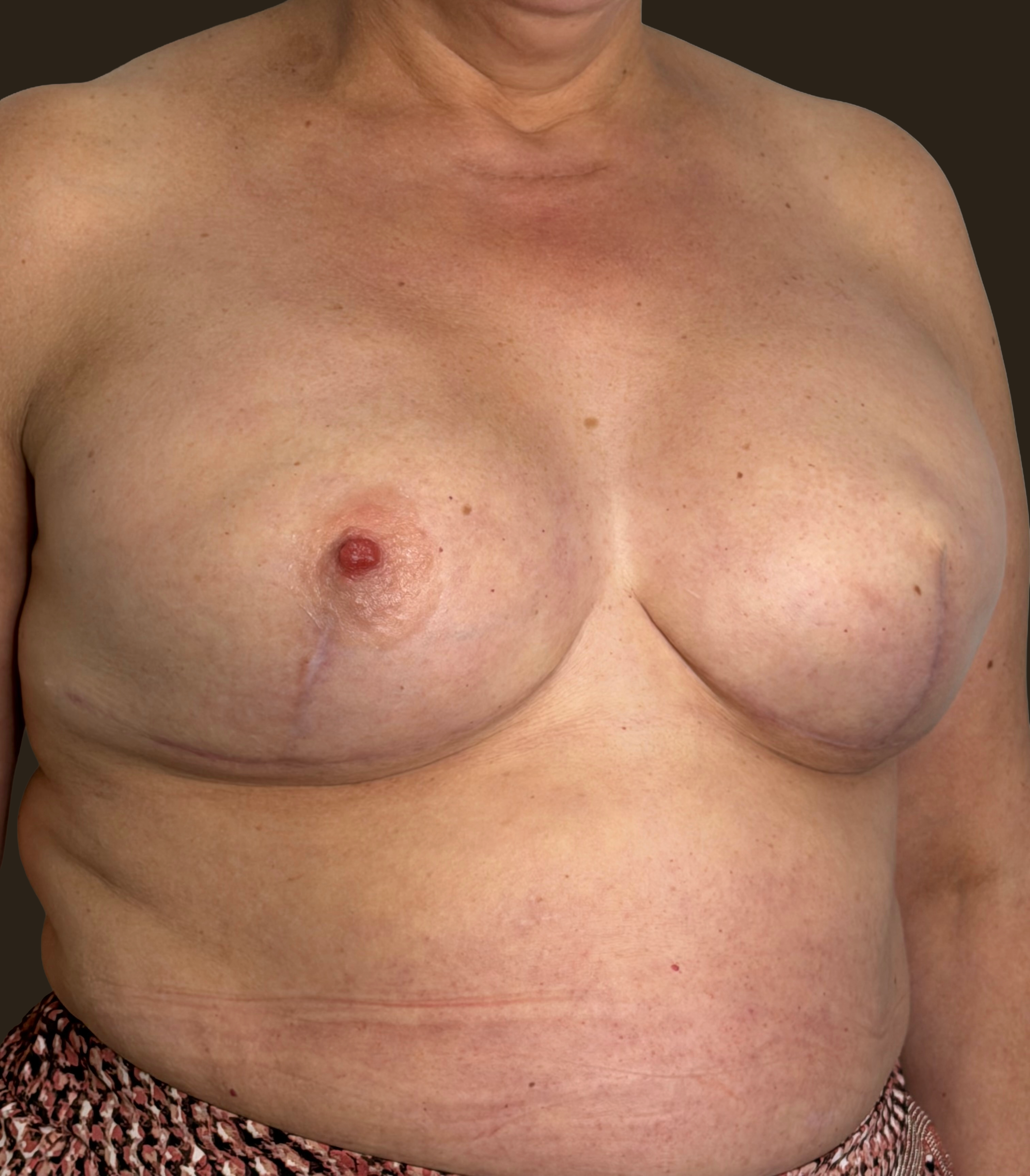 Primera prueba de prótesis de pezón de silicona médica sobre pecho reconstruido, proceso de selección de forma y tono