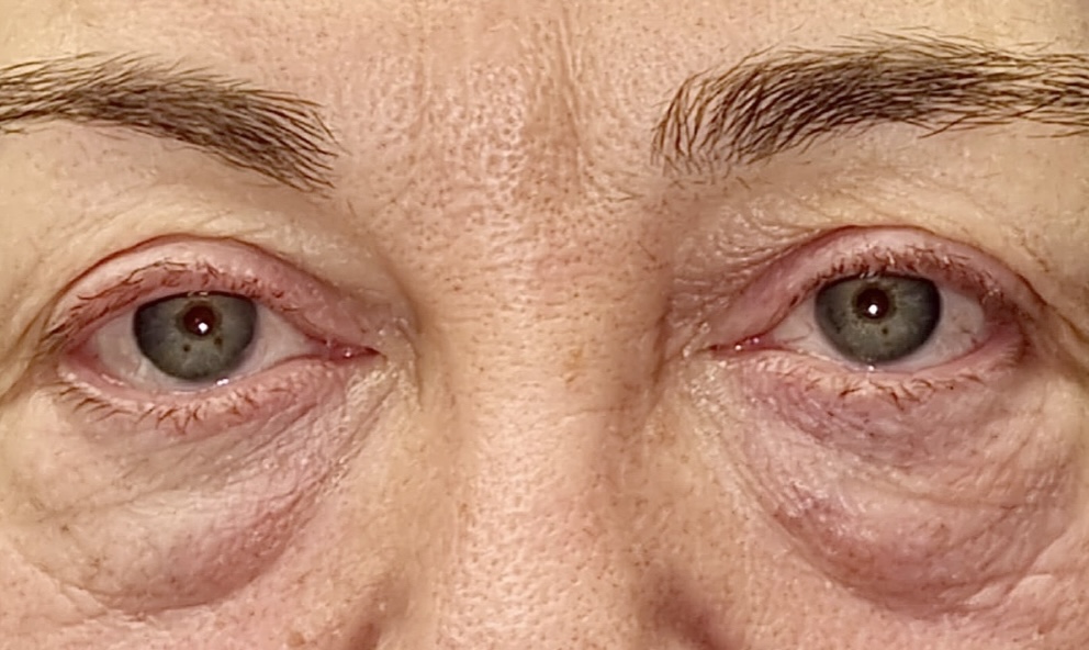 Antes de blefaroplastia — párpados caídos