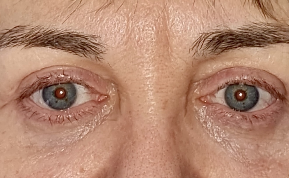 Resultado blefaroplastia superior Bilbao — después de la cirugía