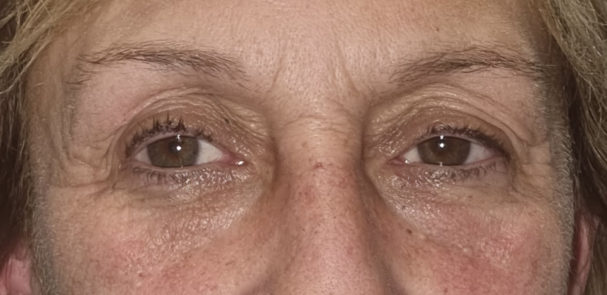 Antes de corrección de ptosis palpebral