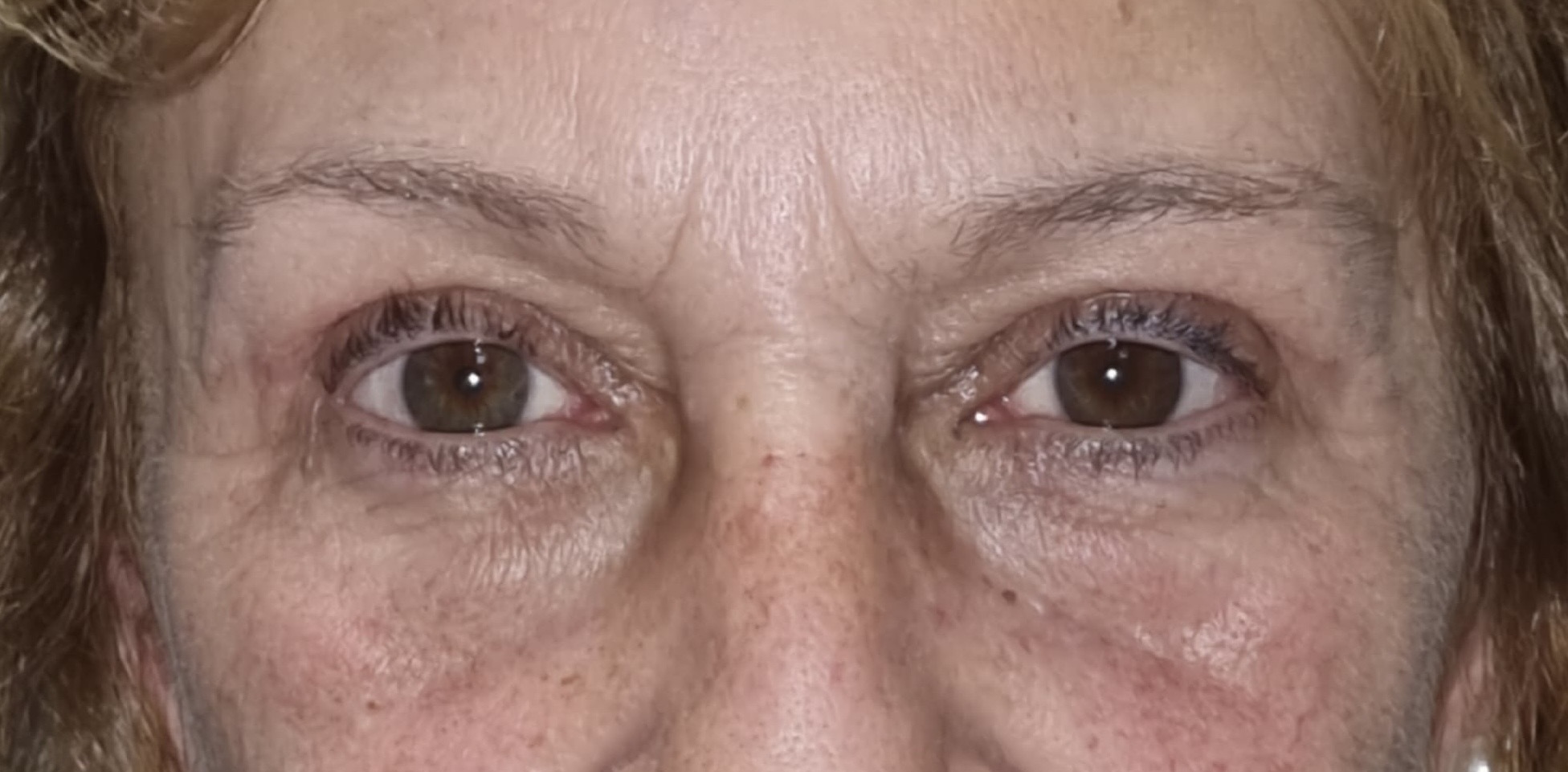Resultado ptosis palpebral Bilbao — después de la cirugía