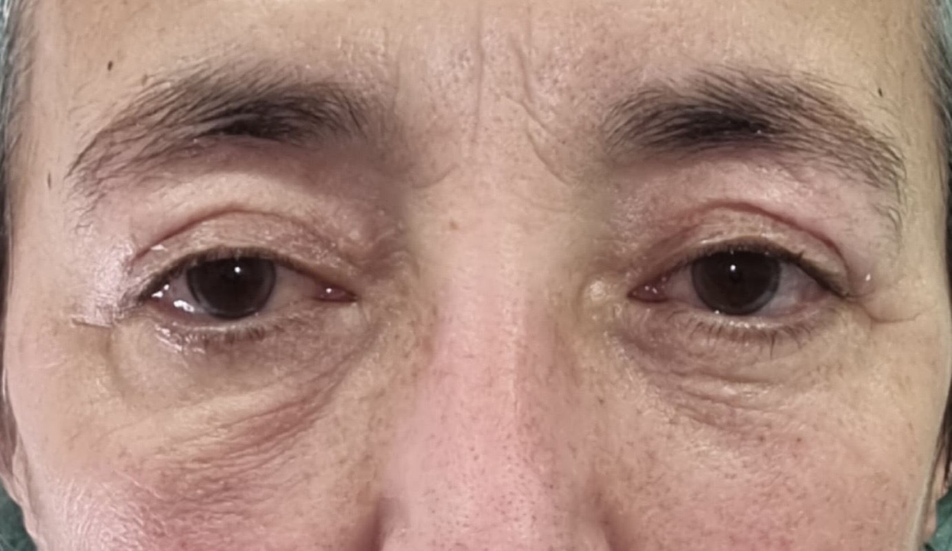Antes de blefaroplastia inferior — bolsas palpebrales