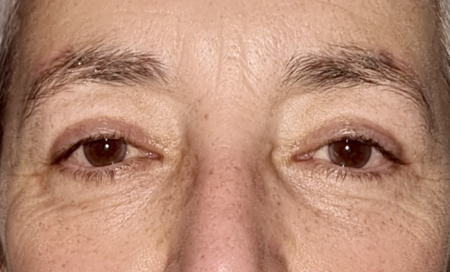 Resultado blefaroplastia inferior Bilbao — después