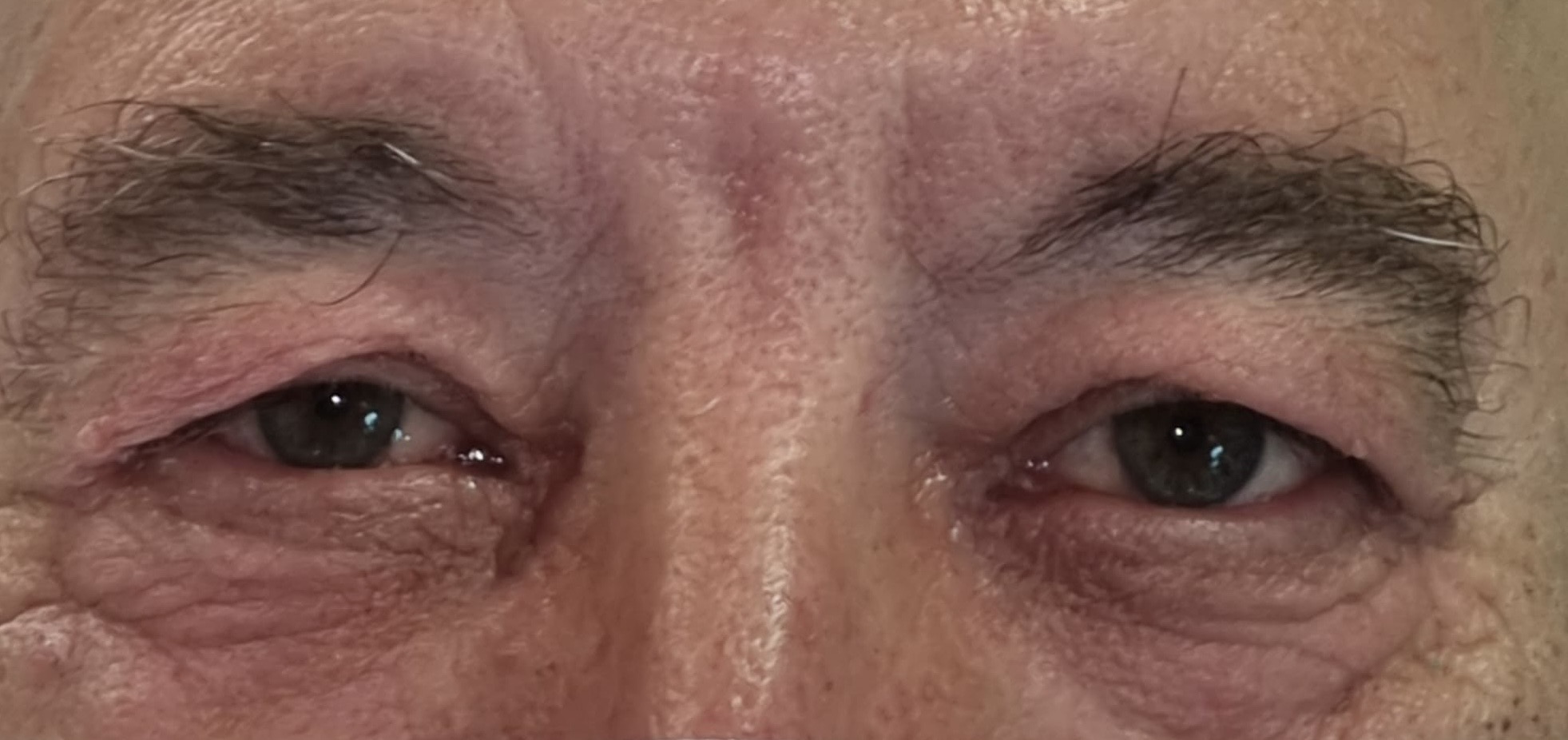 Antes — cirugía oculoplástica caso 4