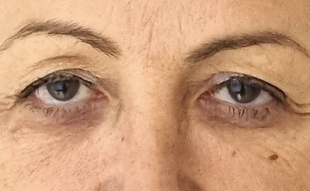 Antes — caso 5 cirugía palpebral Bilbao